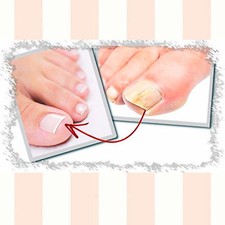 Ony homyc the best nail fungus non -pharmacological treatment Proven efficacy