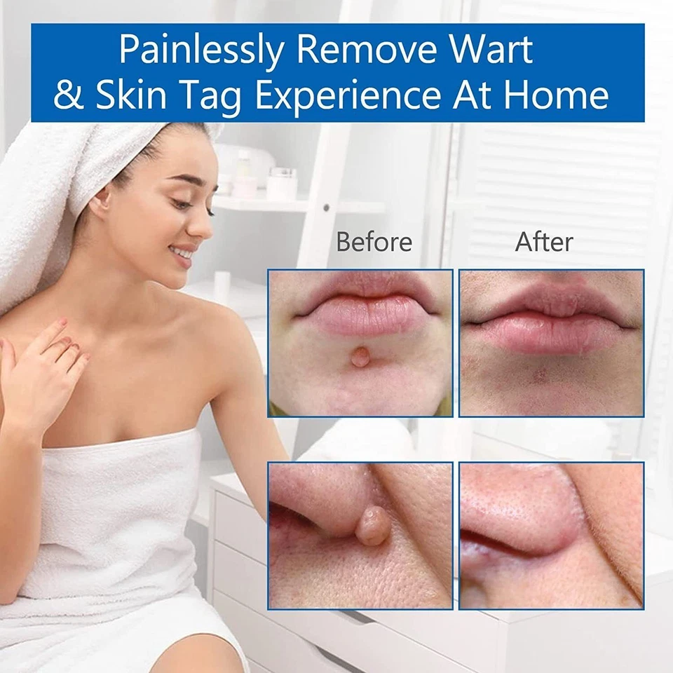 Skin Tag Remover Pen PAINLESS Skin Tag Wart Removal Kit For Small to Large Tags - Image 3 of 4