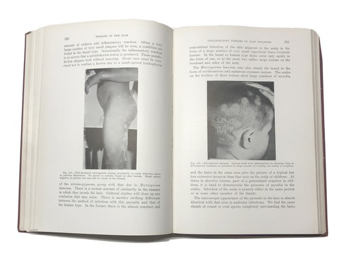 1940 Diagnosis And Treatment Of Diseases Of The Hair by Lee McCarthy MD Mosby Co - Picture 11 of 12