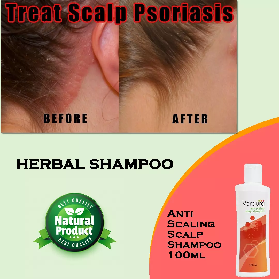 Best shampoos for itchy scalp deals