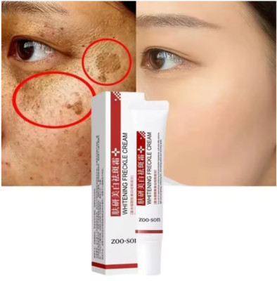 Effective Whitening Freckle Cream Remove Dark Spot Cream Removal Melanin Melasma