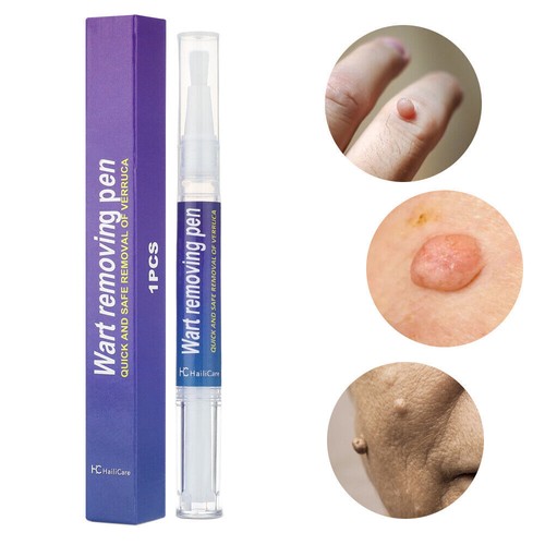 2Stk Wart Remover Pen Skin Tag Mole Remover Eliminate Foot Corn Warts 12 Hours - Bild 13 von 15