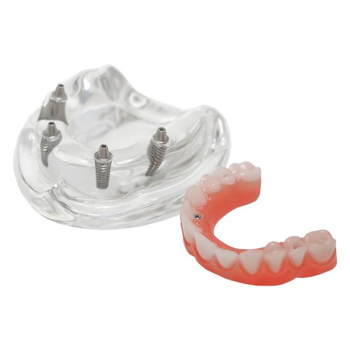 US Dental All-on-4 Overdenture Implant Model, Upper/Lower Jaw-Clear,With 4 Screw - Picture 32 of 51