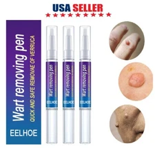 4× Painless Wart Remover Pen Eliminate Skin Tag Foot Corn Mole Warts Restoration