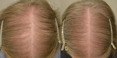 dht blocker with immune support - DHT BLOCKER HAIR FORMULA - dht hair 2B - Picture 4 of 7