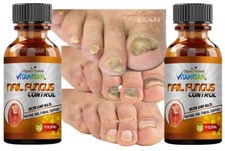 Athlete's Foot,Ringworm,Scabies Antifungal 2oz Tumba Hongos For fungus 2
