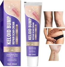 Keloid Bump Removal, Scar Removal Cream for Surgical Marks, Burns and Keloid ...