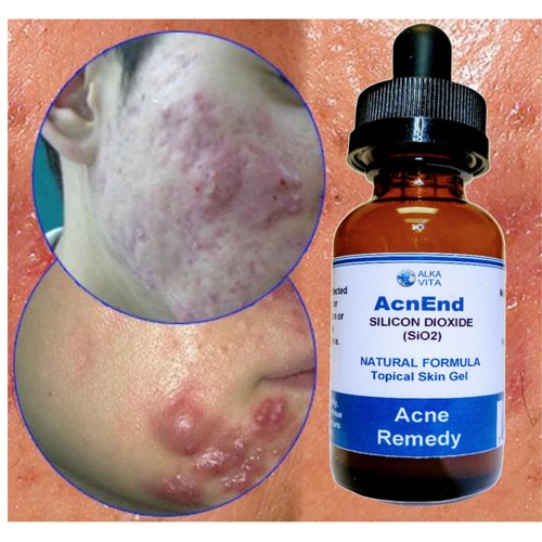 Acne Cystic Gel Remedy Silicon Dioxide AcnEnd Skin Care Fast Results ALKA VITA - Picture 3 of 7