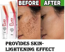 Melasma Cream 25gm Whitening For Dark Spot Severe Anti-Acne 100% Safe Effective
