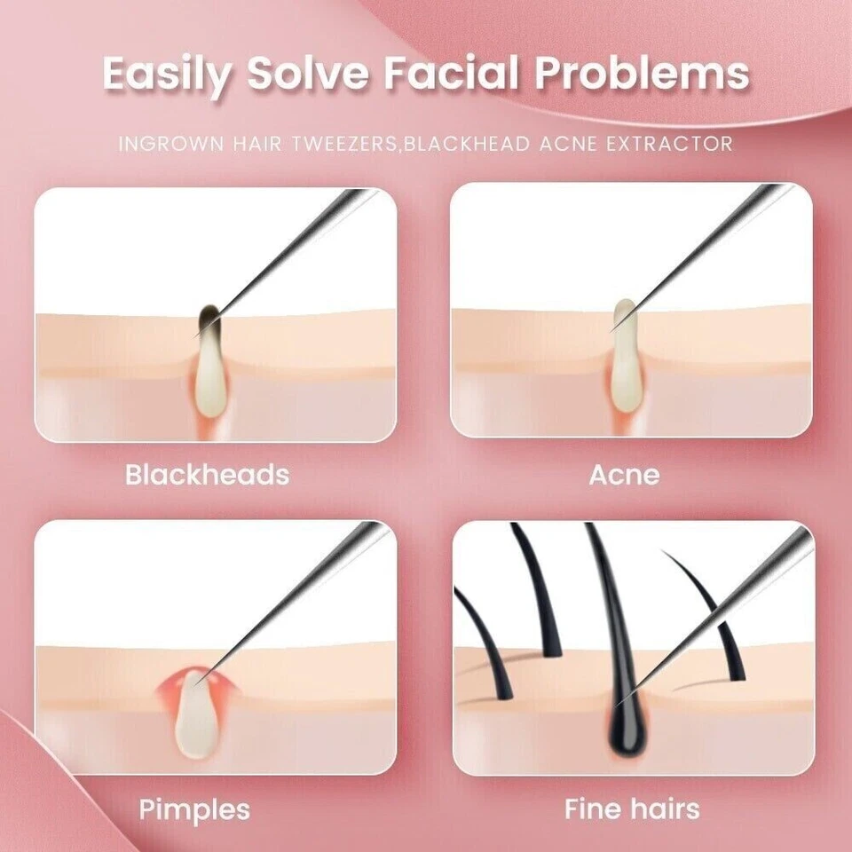 Acne Needle Blackhead Remover Pimple Blemish Comedone Extractor Tweezer Tool Kit - Image 4 of 4