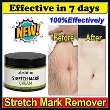 Best Scar Removal-Cream for Old-Scars Stretch Mark Removal Cream for Men  women