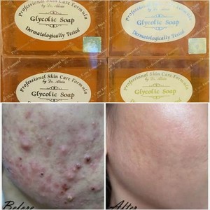 soap for anti pimples