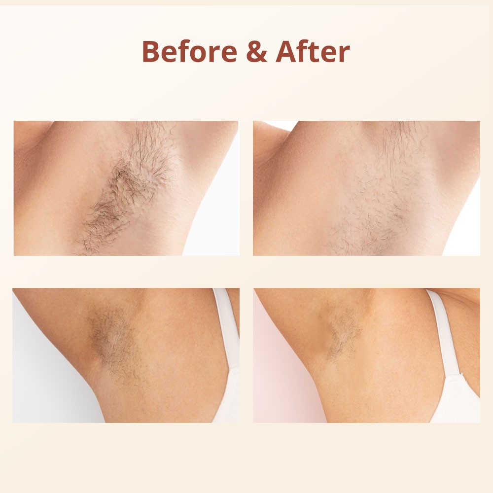 NAISIGOO Permanent Ice Cooling IPL Laser Hair Removal Body Epilator Ice-Cooling