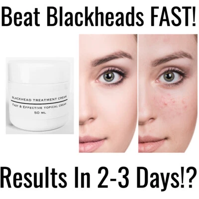 RM WELLNESS Blackhead Cream Advanced Acne Strong Spot Remover Treatment Pimple Comedone 50g