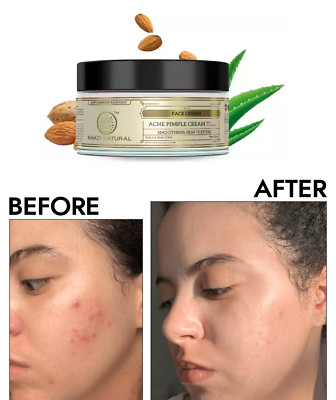 Khadi Natural Ayurvedic Acne Pimple Cream Makes Skin Soft And Smooth 50gm