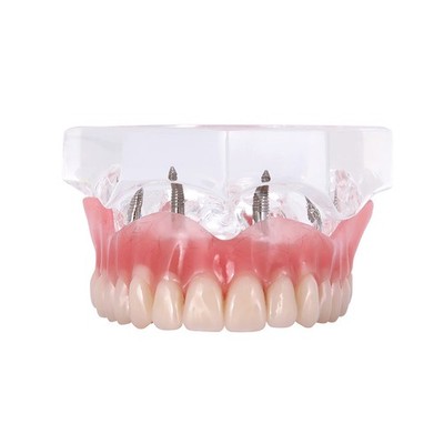 Dentalmall Dental Upper Implants Model Overdenture with 4 Superior Teeth Demo...