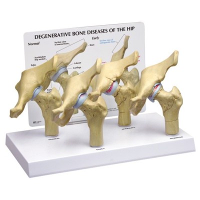 HipJoint Osteoarthritis GPI Anatomical Set of 4  LFA#1320 Make Us An Offer VIDEO