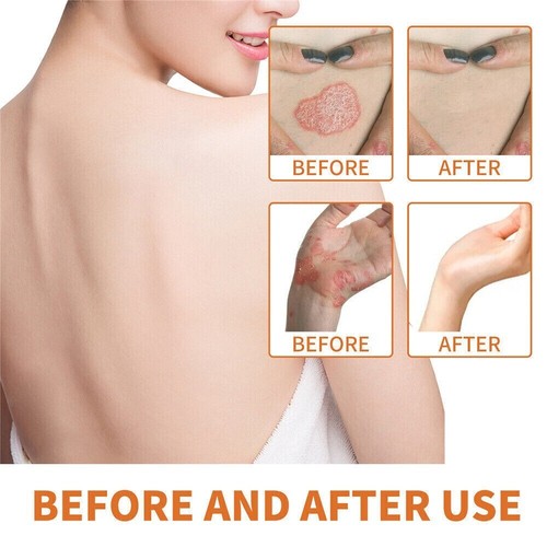Bee Venom Psoriasis Treatment Cream Dermatitis Eczema Healing Antibacterial Care - Picture 7 of 14