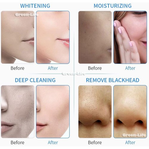 Blackhead Remover Pore Vacuum Cleaner Acne Extractor Magic Oxygen Bubble Machine - Picture 12 of 13