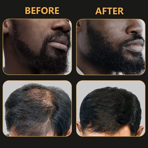 1 Rodillo De Titanio Para El Crecimiento & Cuidado La Barba, Beard Derma Roller - Picture 8 of 15