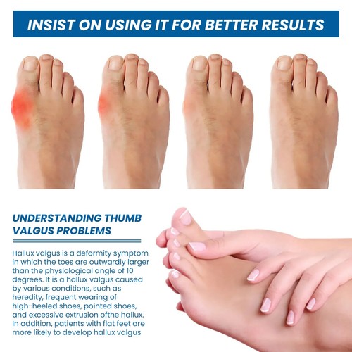 Toe Separator Correction Hallux Valgus Corrector Silicone Orthopedic Hammer Se - Picture 4 of 11