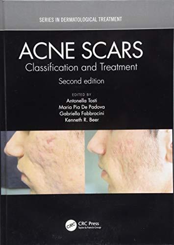 Acne Scars: Classification and Treatment, Second Edition (Series in Dermatological Treatment) - Image 3