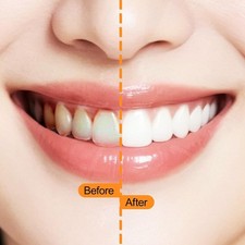 180 Pcs Interdental Brushes, Braces Brush with Individual Packaging, Soft Bri...