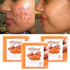 Turmeric Soap Skin Whitening Dark Spots lightening Acne Brightening 100g
