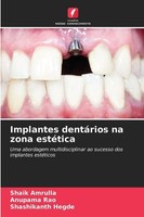 Implantes DentáRios Na Zona EstéTica Shashikanth Hegde
