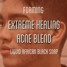 Fra Fra's Naturals  Premium EXTREME Healing Acne Foaming African Black Soap Fac