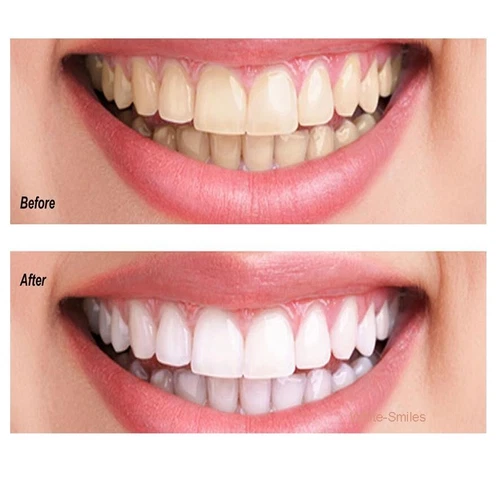 ADVANCED TEETH WHITENING GEL STRONG DENTAL GRADE PROFESSIONAL TOOTH WHITENING - Picture 16 of 44