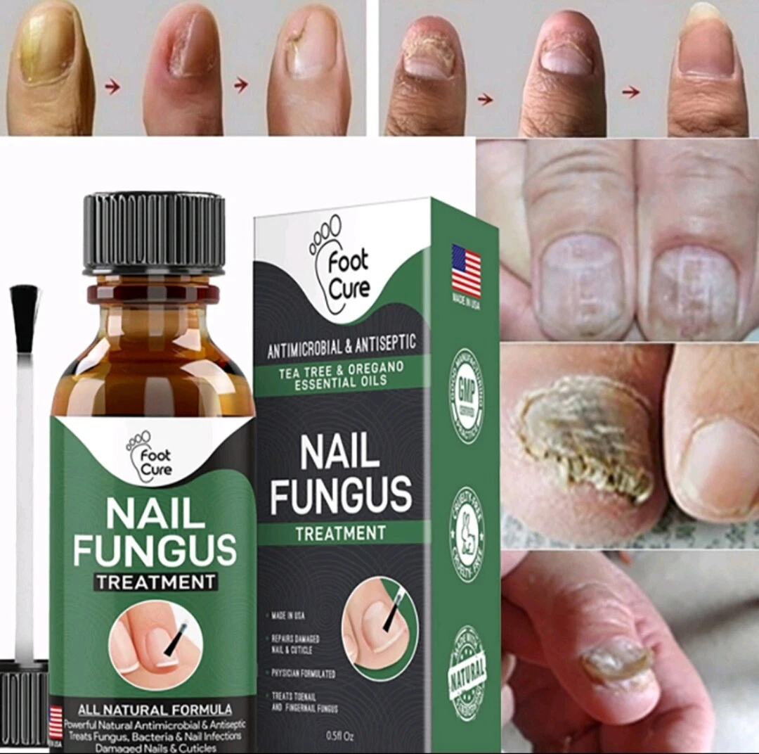 What Should I do If My Nails Are Fungal? – Care For Feet