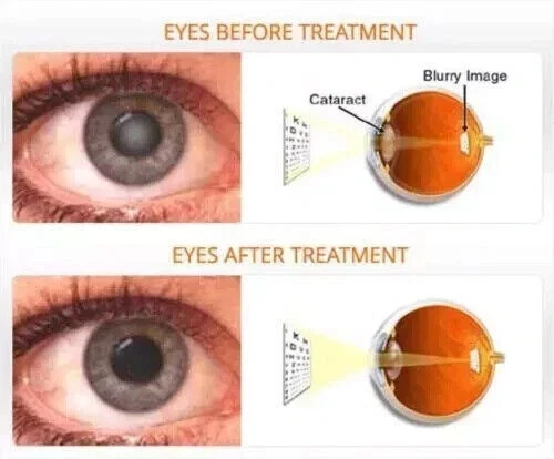 10 Bottiglie Ujala Collirio Ayurvedico Cura Erboristica per Cataratta e Supporto Visivo - Foto 3 di 7