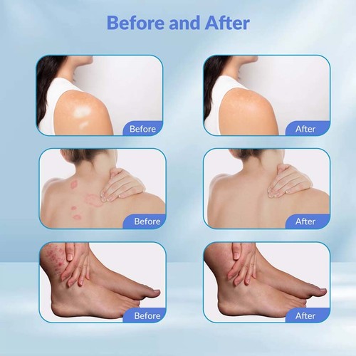 308nm Excimer UVB Light Therapy Device For Plaques & Hyperproliferation 6 Diodes - Picture 7 of 21