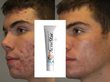 Acnestar Gel PIMPLE CREAM 22 gm free shipping usps