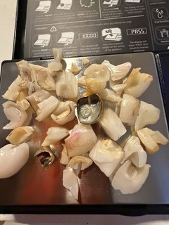 Estate Lot Extracted Human Teeth w/ Dental Gold Crowns Scrap Gold Collectible