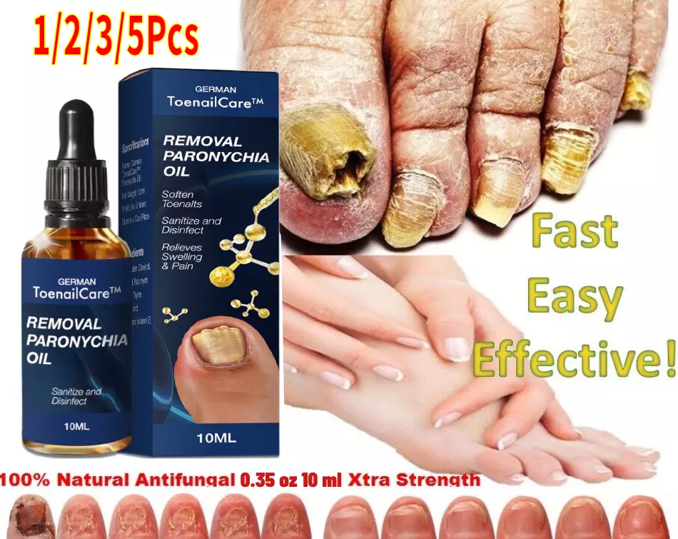 Toenail fungus treatment deals