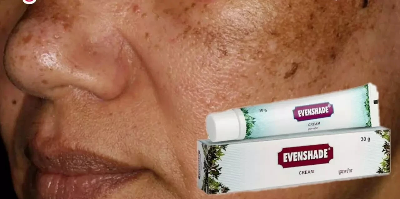 Ayurvedic melasma Treatment Cream 30gm skin pigmentation like melasma, chloasma