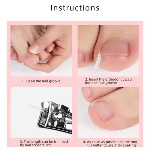 Corrector de uñas almohadilla de uñas encarnada ranura herramienta para el cuidado de los pies corrector de uñas de los pies 50 un. - Imagen 9 de 16