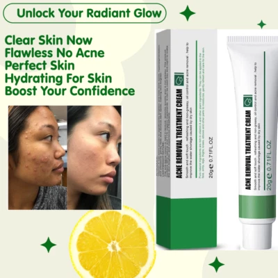New Effective Acne Removal Cream Acne Treatment Skin Whitening Pimple Acne 20g