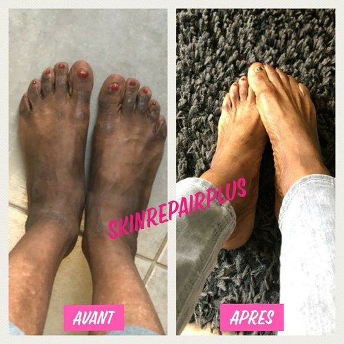 Crème SOIN Effaceur d'hyperpigmentation pour phalanges, pieds - Zdjęcie 13 z 17