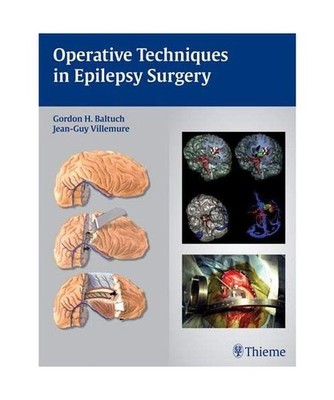 Operative Techniques in Epilepsy Surgery
