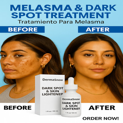 Derma Snow Melasma & Dark Spot Treatment   Extra Strength Skin Lightener
