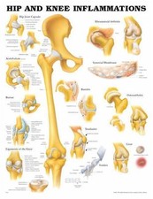 Hip  Knee Inflammations, Anatomical Chart/Charts/Model