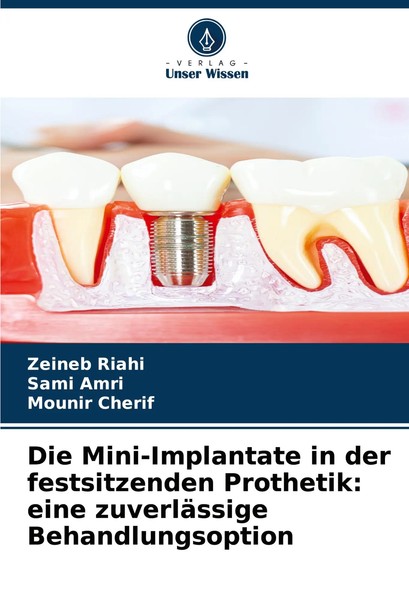 Die Mini-Implantate In Der Festsitzenden Prothetik: Eine ZuverläSsige...-image