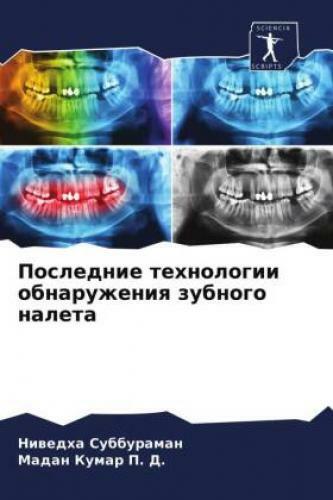 Poslednie tehnologii obnaruzheniq zubnogo naleta 6297