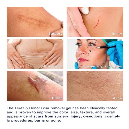 Scar Remover Gel for C-Section, Stretch Marks, Acne, Surgery, Old and New Scars - Picture 7 of 7