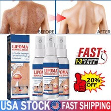 1-5PC Lipomheilung Reduction Spray,Instant LumpFree Lipoma Removal Spray USA Hot
