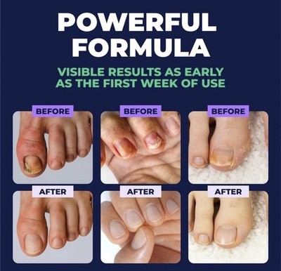 5Pcs NEW Anti Fungal Pen Intensive Treatment Toenail Fungus Foot Nail Repair Oil