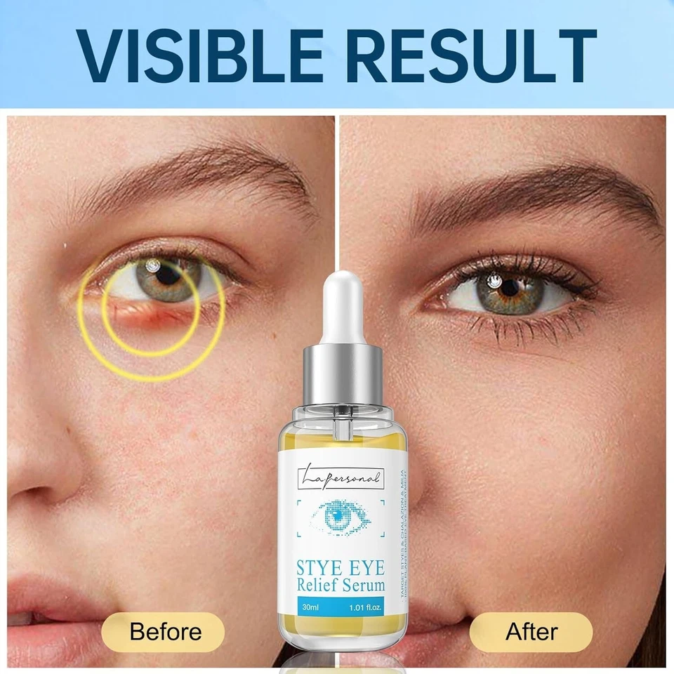 Tratamiento para ojos con orzuelo, crema para ojos con suero para ojos para chalazión y blefaritis 1,01 fl oz Foto 4 de 4